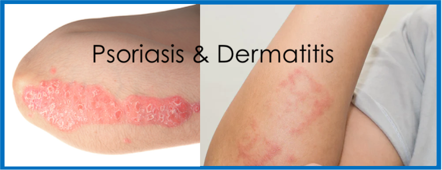 Psoriasis and Dermatitis